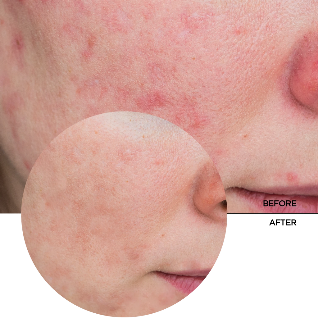 Revox Azelaic Acid 10% 30ml